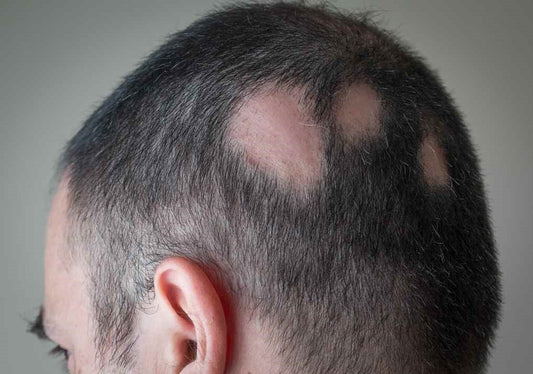 HOME REMEDIES FOR ALOPECIA AREATA - Guduchi Ayurveda