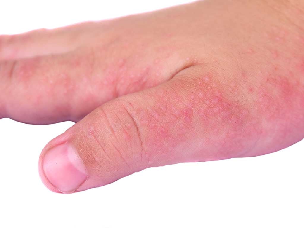 HOME REMEDIES FOR ECZEMA (DERMATITIS) - Guduchi Ayurveda