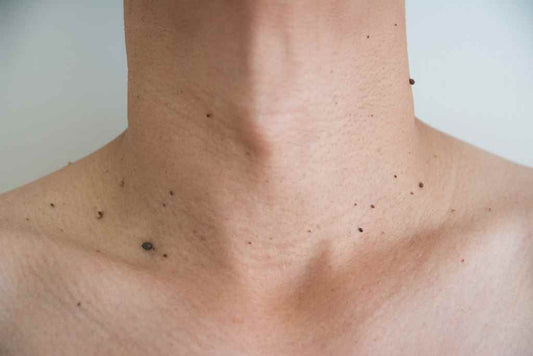 HOME REMEDIES FOR MOLES - Guduchi Ayurveda