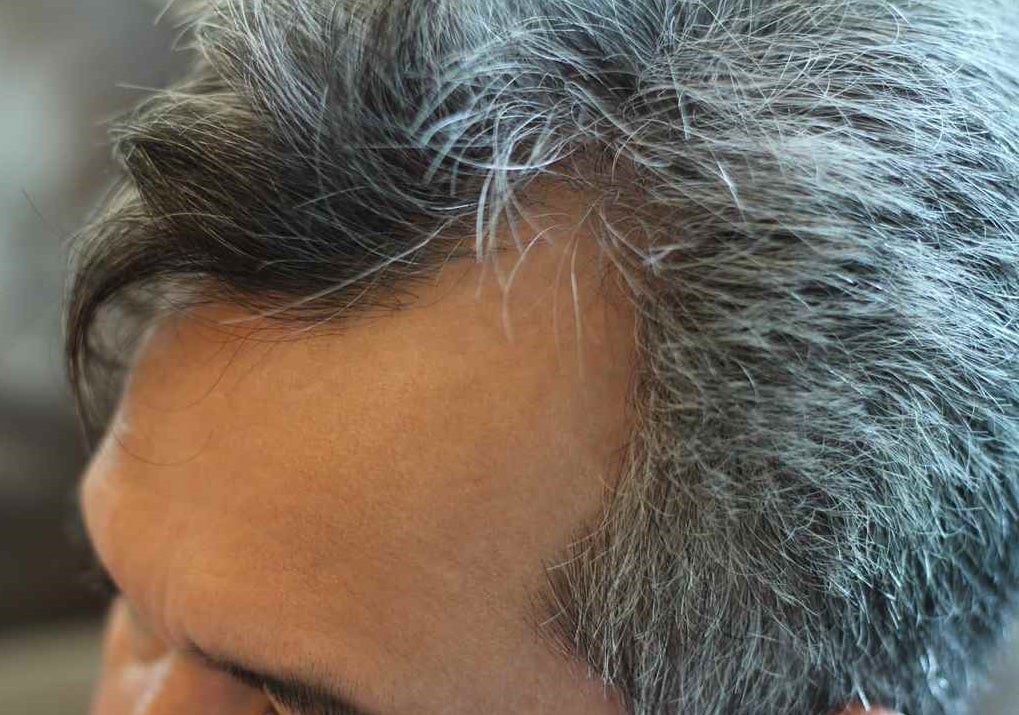 HOME REMEDIES FOR PREMATURE GREYING OF HAIR - Guduchi Ayurveda