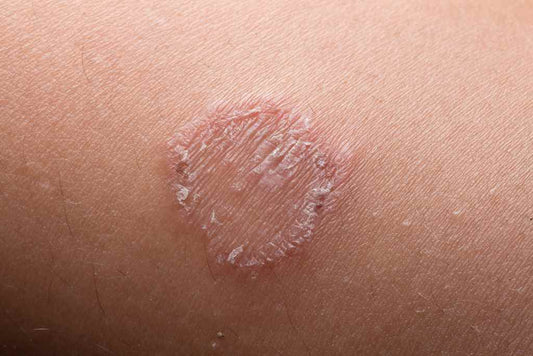 HOME REMEDIES FOR RINGWORM - Guduchi Ayurveda