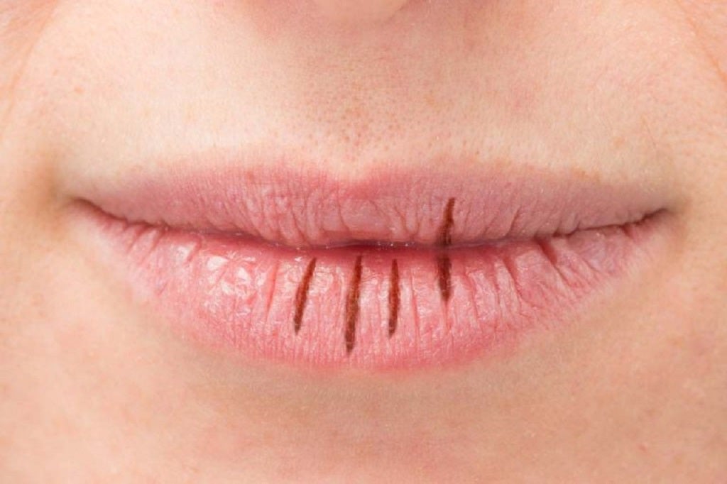 HOME REMEDIES TO GET RID OF CRACKED, CHAPPED AND DRY LIPS - Guduchi Ayurveda